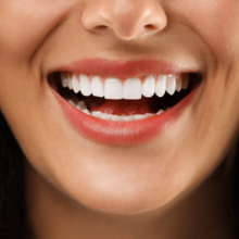 facetas em resina bh