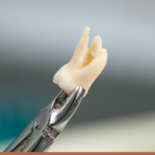 extração de siso bh