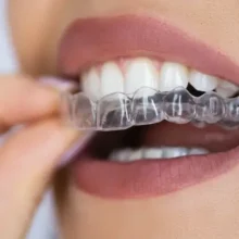 alinhador estético invisalign bh